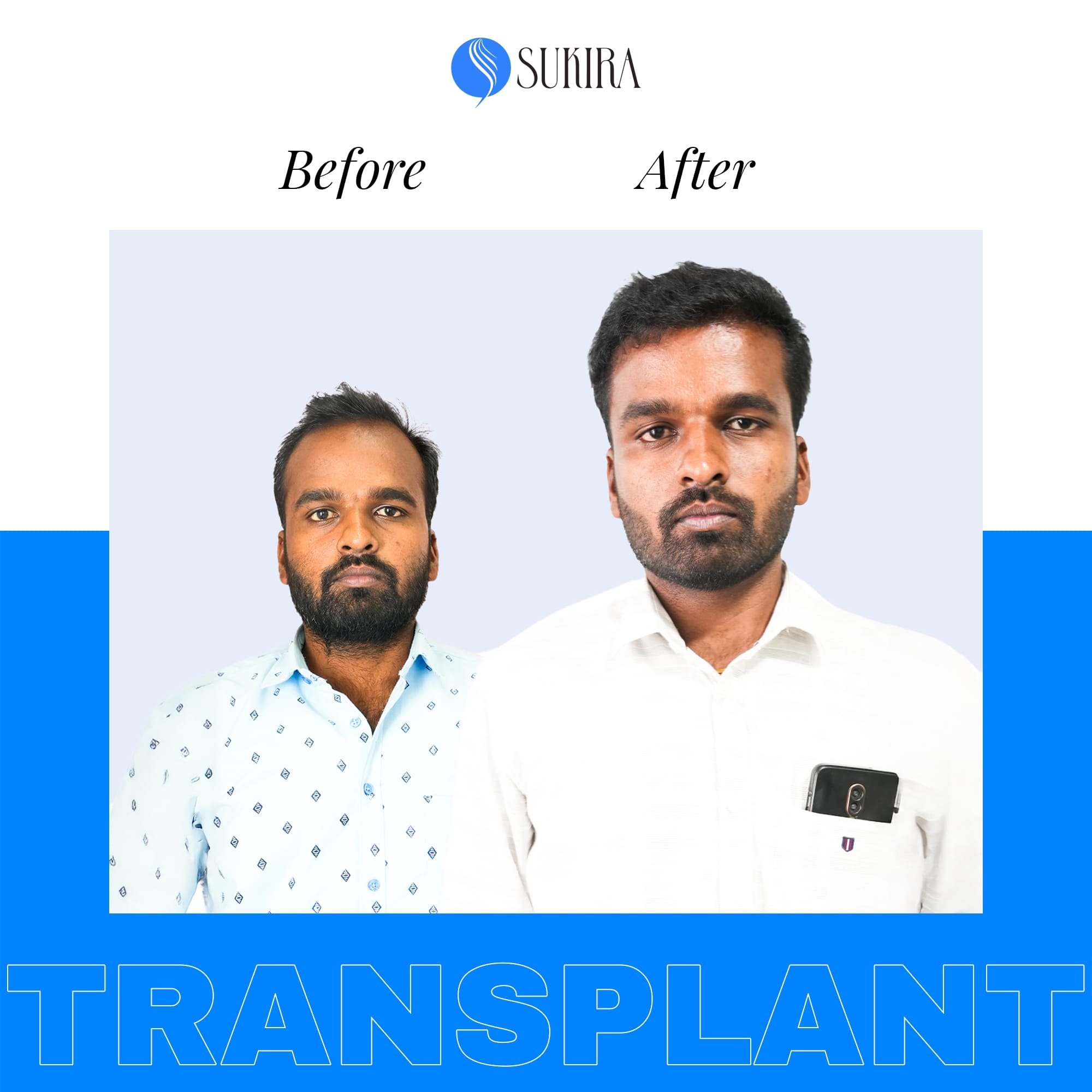 Hair Transplant ba 1