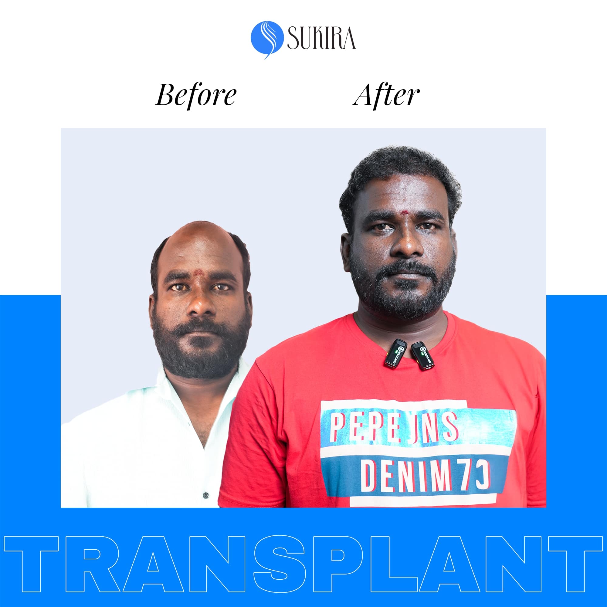 Hair Transplant ba 2
