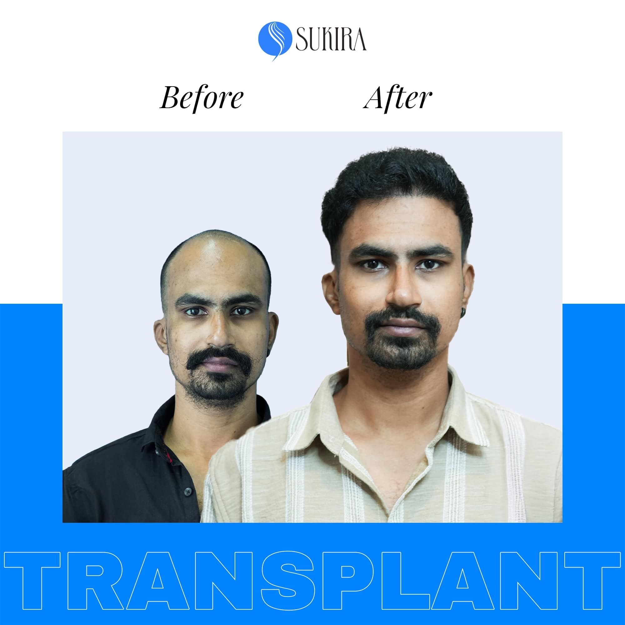 Hair Transplant ba 3