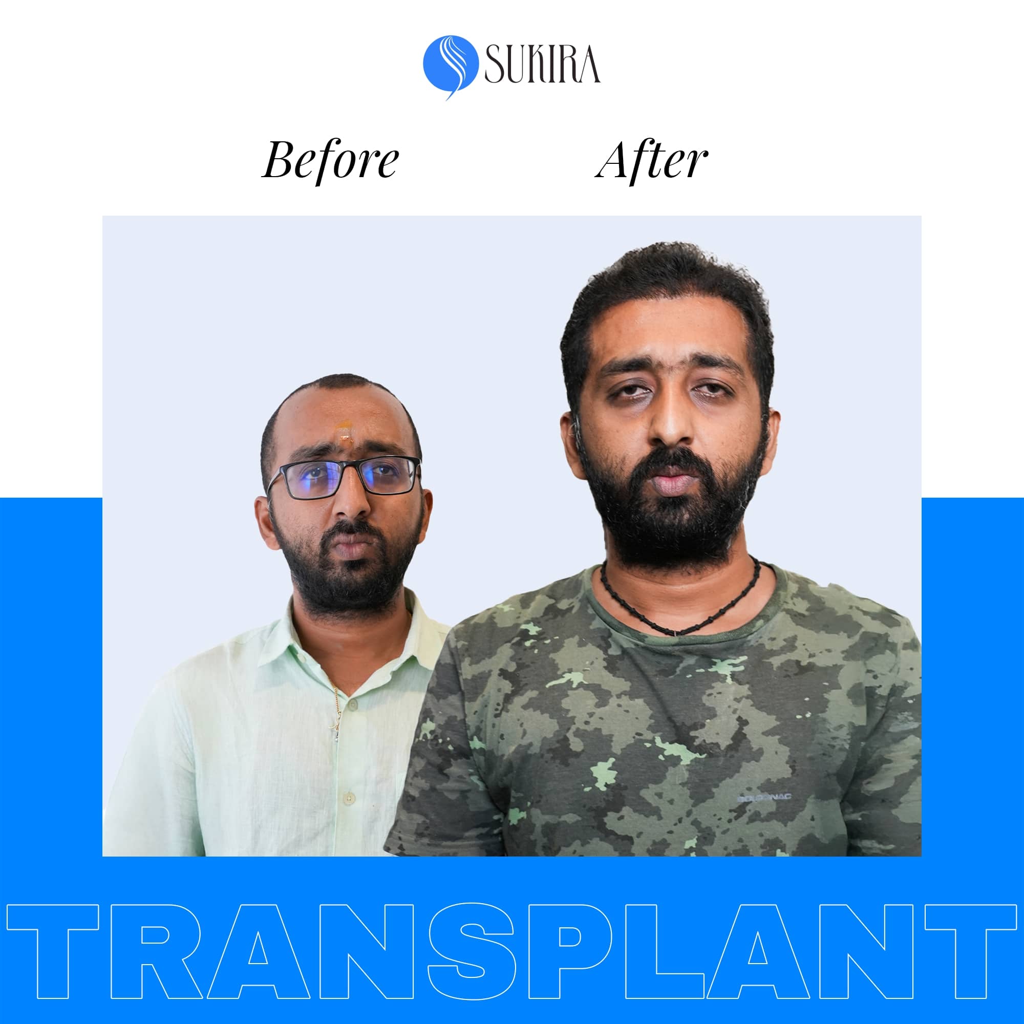 Hair Transplant ba 4