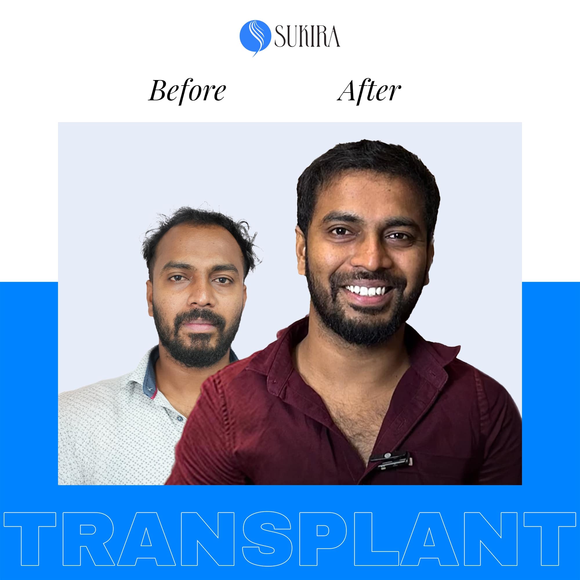 Hair Transplant ba 5