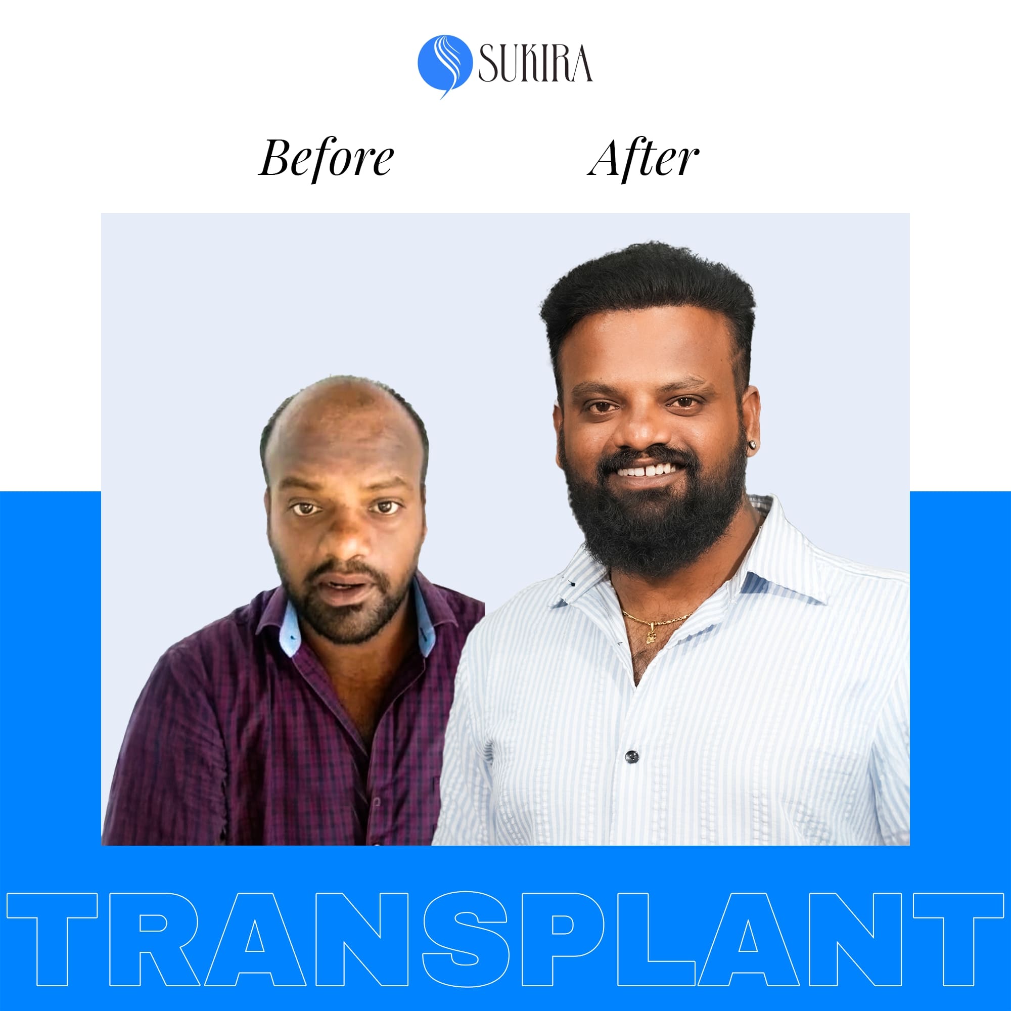 Hair Transplant ba 6